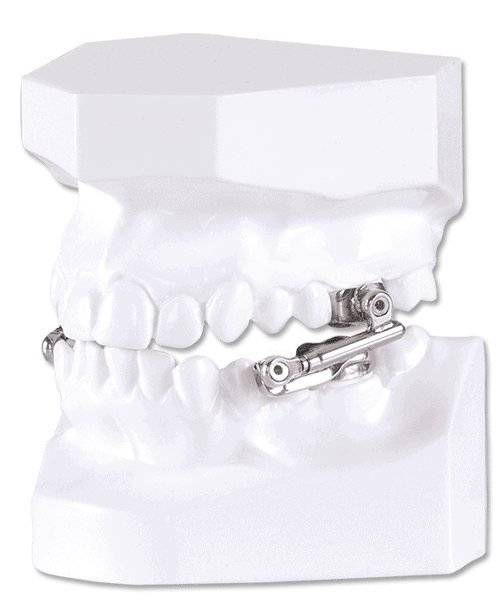 Herbst Orthodontic Appliance DynaFlex