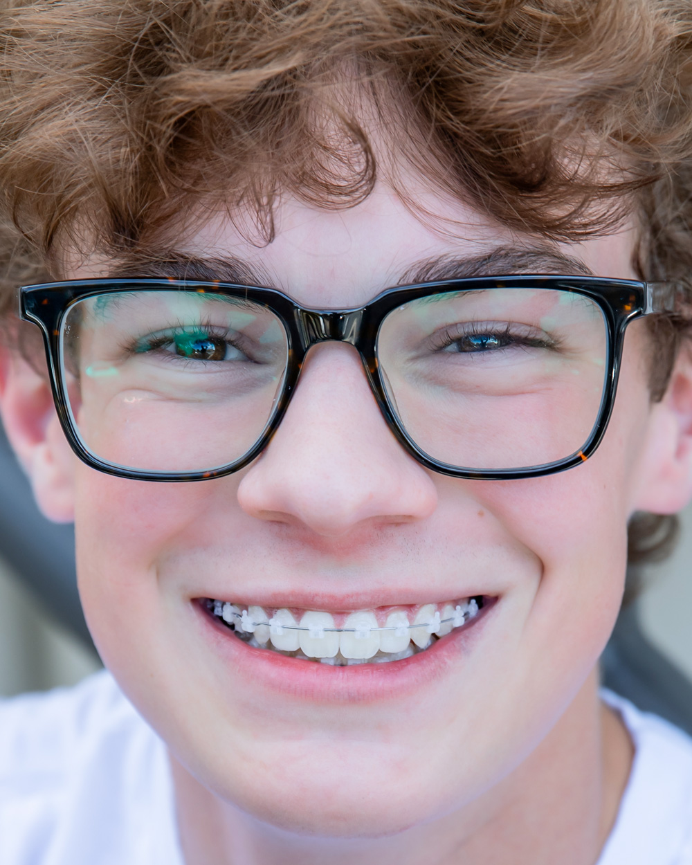 Norris-Clear-Bracket-Patient2