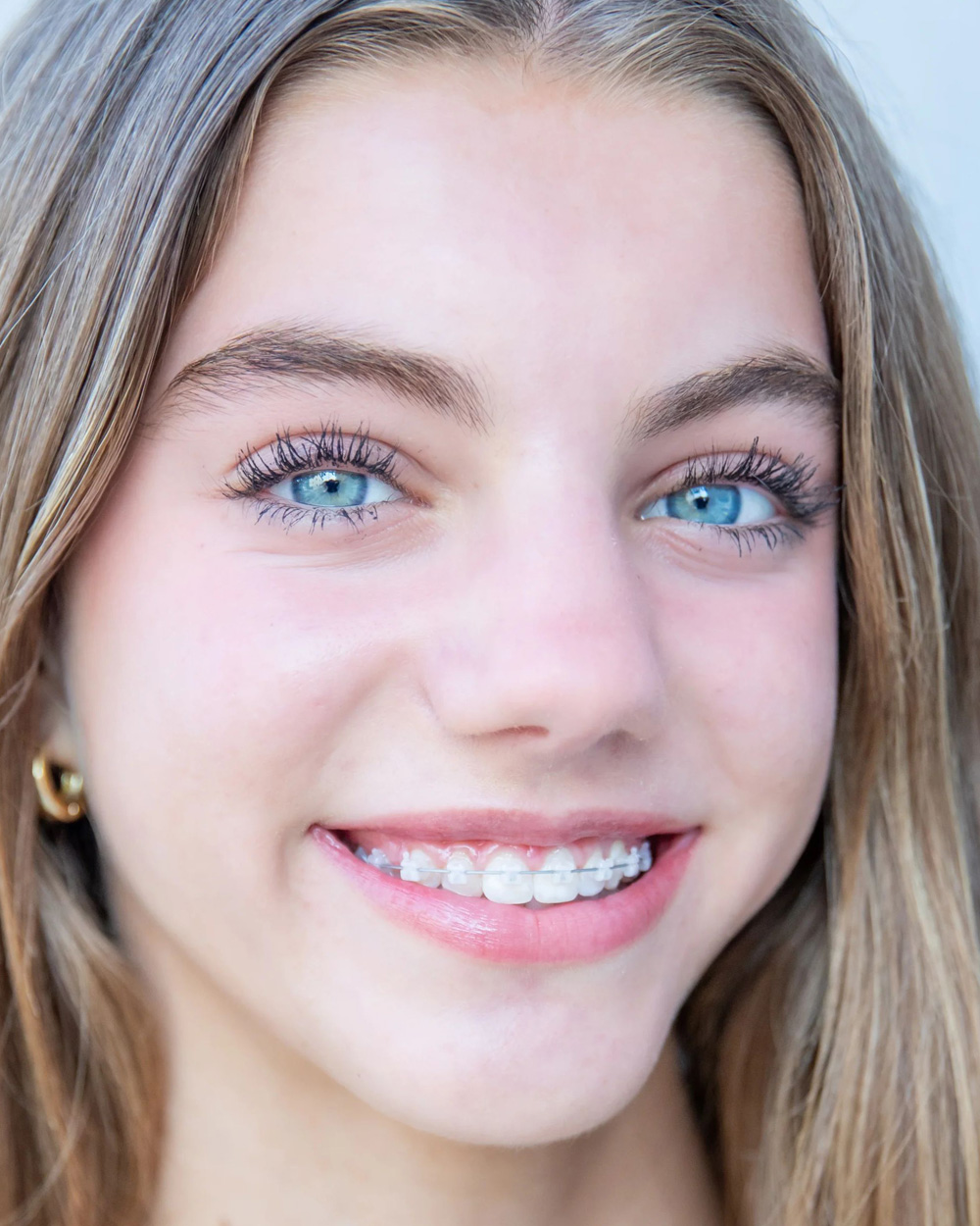 Norris-Clear-Bracket-Patient6