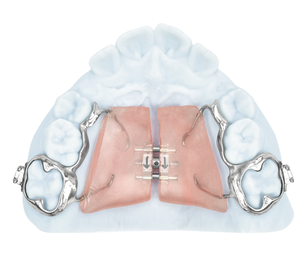 fixed-expander SmartJet