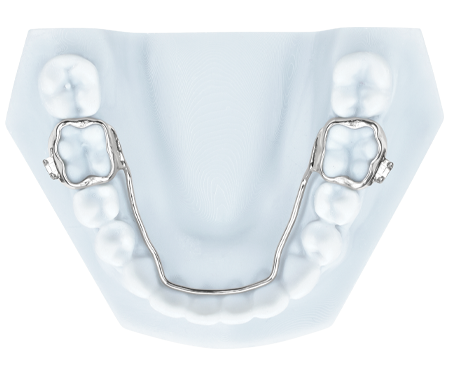 lingual-holding-arch-3d-metal-printed-bands
