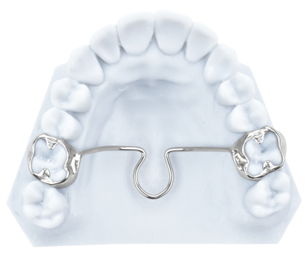 transpalatal-arch-3d-metal-printed-bands